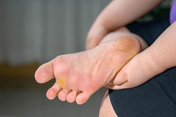 Corn and Callus Treatment