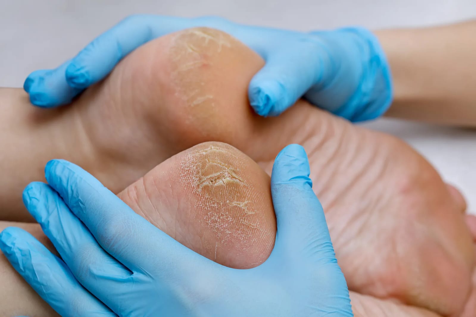 Verruca Treatment